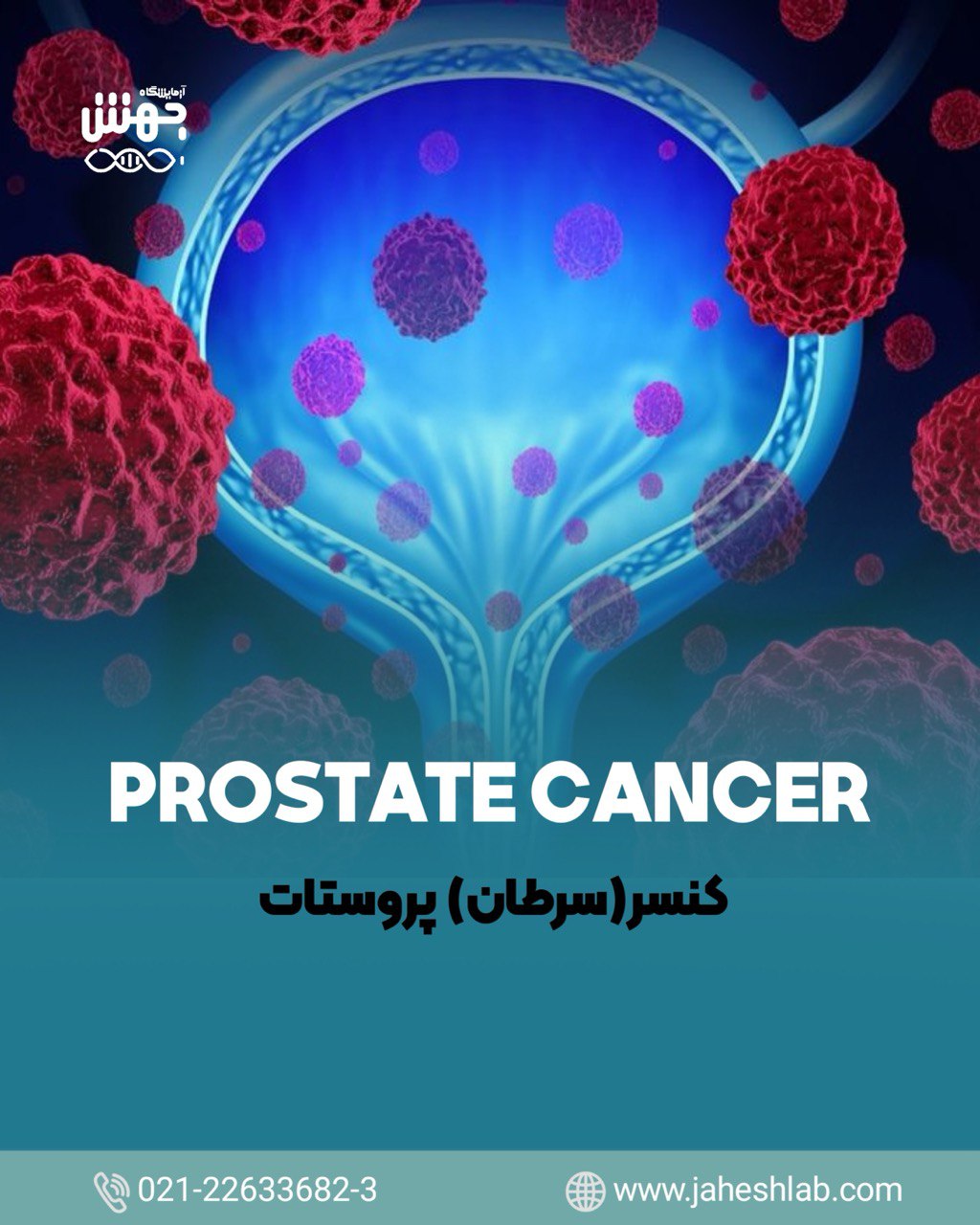 نشانگرهای پیش‌بینی‌کننده مراحل مختلف سرطان پروستات